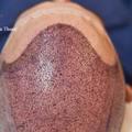 Thane’s Premier Hair Transplant Specialists – DNA Royal Aesthetic Clinic.